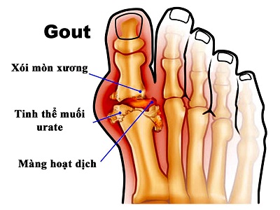 dấu hiệu bệnh gút gout xương bàn chân